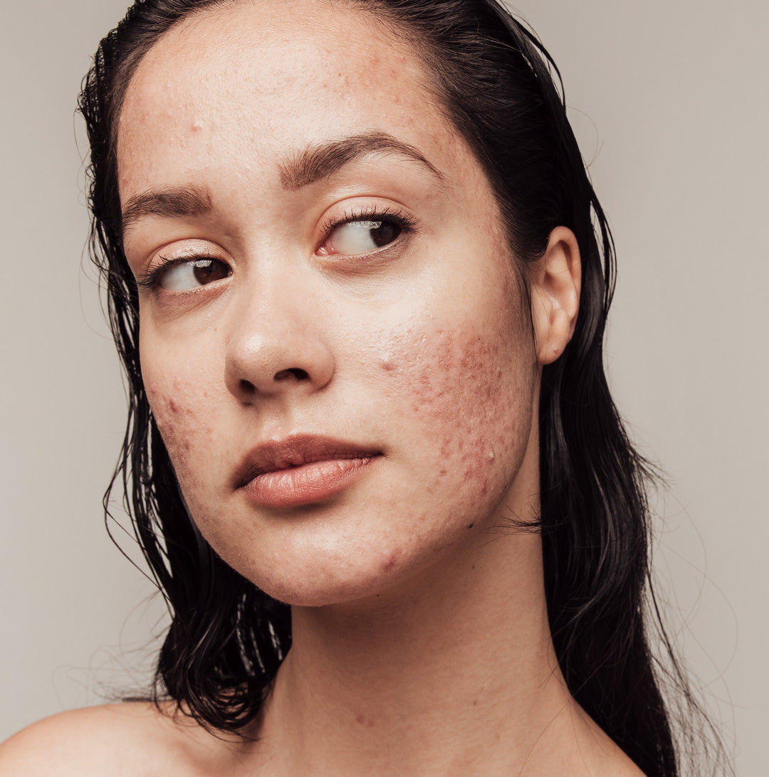 Managing Hormonal Acne: Your Complete Guide to Healthy, Clear Skin